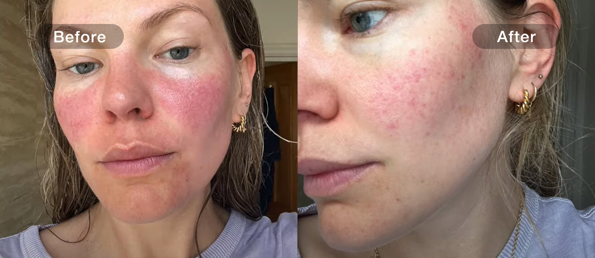 JOVS-reported redness comparison for the matching 4D model